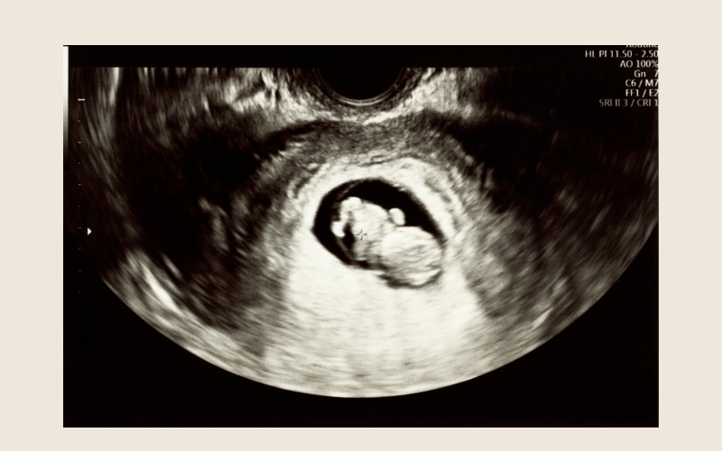 Why Taking Folic Acid Isn't Always Enough